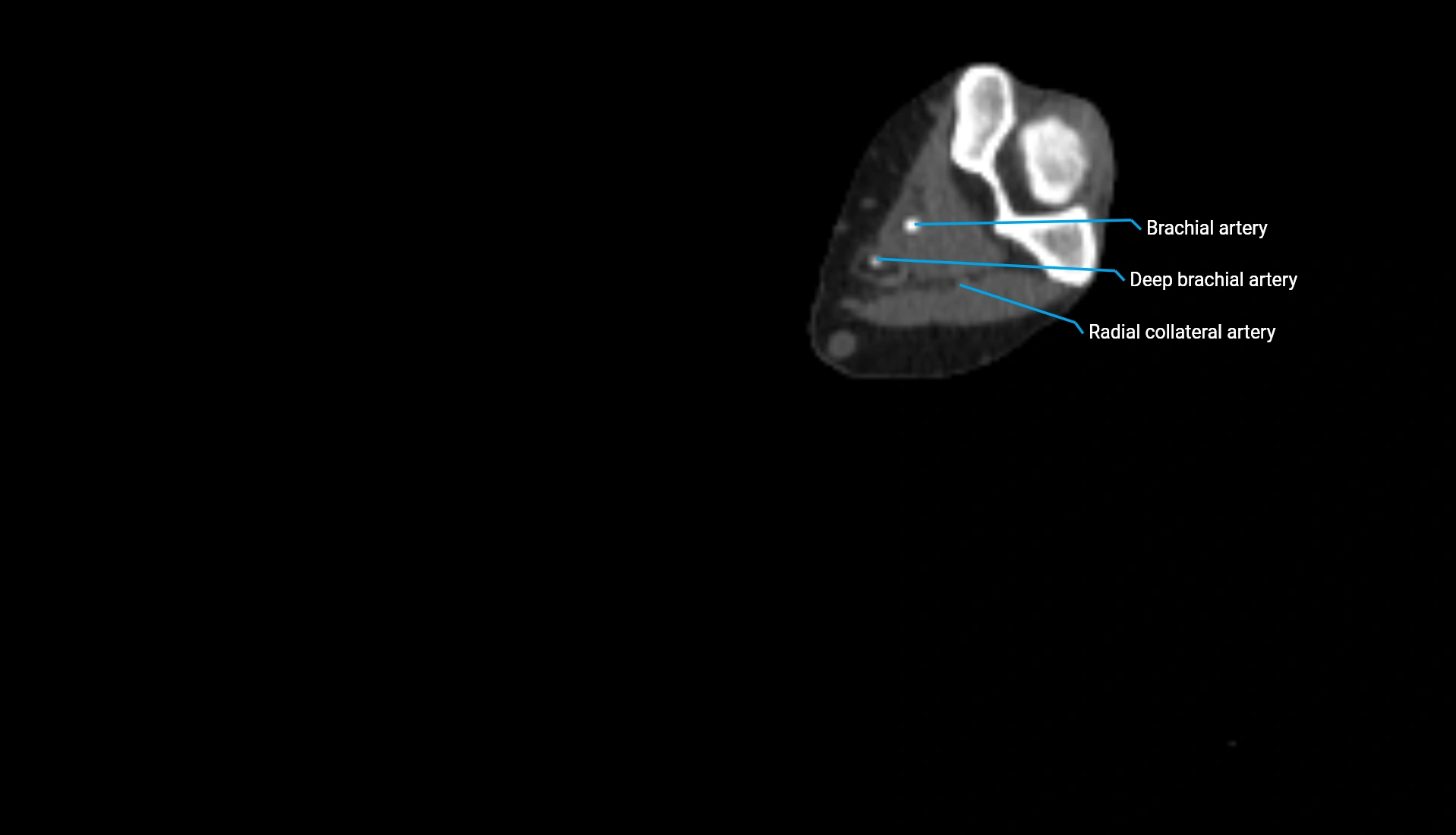 CTA upper limb axial cross sectional anatomy labelled image 194 (2).webp